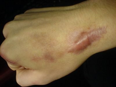 Cicatriz queloides y tatuajes